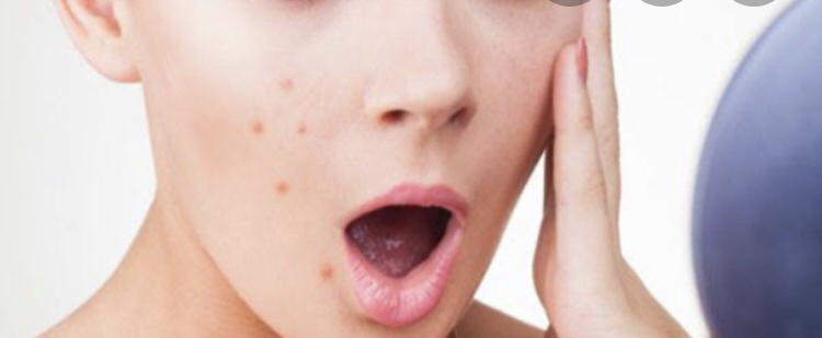 フェイシャル専門家が伝える 即効性のあるニキビができた時の対処法 市販でok Galichu